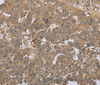 Immunohistochemistry of paraffin-embedded Human ovarian cancer tissue using STMN2/3/4 Polyclonal Antibody at dilution 1:45
