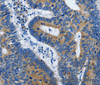 Immunohistochemistry of paraffin-embedded Human colon cancer using BPIFB3 Polyclonal Antibody at dilution of 1:50