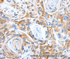 Immunohistochemistry of paraffin-embedded Human esophagus cancer tissue using LRIG3 Polyclonal Antibody at dilution 1:50