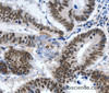 Immunohistochemistry of paraffin-embedded Human colon cancer tissue using LRP5 Polyclonal Antibody at dilution 1:55