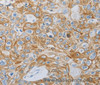 Immunohistochemistry of paraffin-embedded Human esophagus cancer tissue using MC5R Polyclonal Antibody at dilution 1:60