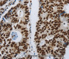 Immunohistochemistry of paraffin-embedded Human colon cancer tissue using SLC16A14 Polyclonal Antibody at dilution 1:80