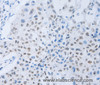 Immunohistochemistry of paraffin-embedded Human lung cancer tissue using c-Fms Polyclonal Antibody at dilution 1:45