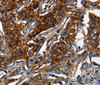 Immunohistochemistry of paraffin-embedded Human lung cancer using ABCC5 Polyclonal Antibody at dilution of 1:50