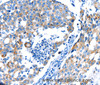 Immunohistochemistry of paraffin-embedded Human breast cancer using POMC Polyclonal Antibody at dilution of 1:30