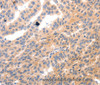 Immunohistochemistry of paraffin-embedded Human ovarian cancer using MYL9 Polyclonal Antibody at dilution of 1:80