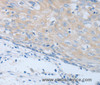 Immunohistochemistry of paraffin-embedded Human cervical cancer using CHRNA7 Polyclonal Antibody at dilution of 1:40
