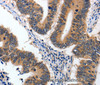 Immunohistochemistry of paraffin-embedded Human colon cancer using 14-3-3 epsilon Polyclonal Antibody at dilution of 1:60