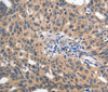 Immunohistochemistry of paraffin-embedded Human ovarian cancer using 14-3-3 epsilon Polyclonal Antibody at dilution of 1:60
