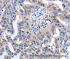 Immunohistochemistry of paraffin-embedded Human ovarian cancer using 14-3-3 theta Polyclonal Antibody at dilution of 1:50