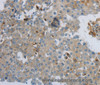 Immunohistochemistry of paraffin-embedded Human breast cancer tissue using CKMT1A Polyclonal Antibody at dilution 1:100
