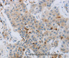 Immunohistochemistry of paraffin-embedded Human lung cancer tissue using CKMT1A Polyclonal Antibody at dilution 1:100