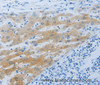 Immunohistochemistry of paraffin-embedded Human liver cancer using NPHS1 Polyclonal Antibody at dilution of 1:50