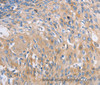 Immunohistochemistry of paraffin-embedded Human cervical cancer tissue using NBEA Polyclonal Antibody at dilution 1:60