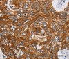 Immunohistochemistry of paraffin-embedded Human esophagus cancer tissue using GRIN1 Polyclonal Antibody at dilution 1:45