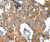 Immunohistochemistry of paraffin-embedded Human breast cancer tissue using GluR2 Polyclonal Antibody at dilution 1:40