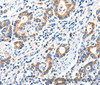 Immunohistochemistry of paraffin-embedded Human gasrtic cancer tissue using GluR2 Polyclonal Antibody at dilution 1:40
