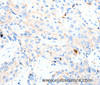 Immunohistochemistry of paraffin-embedded Human esophagus cancer tissue using P2RY1 Polyclonal Antibody at dilution 1:50