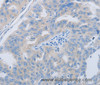 Immunohistochemistry of paraffin-embedded Human ovarian cancer using PAWR Polyclonal Antibody at dilution of 1:60