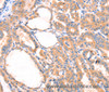 Immunohistochemistry of paraffin-embedded Human thyroid cancer using PRDX2 Polyclonal Antibody at dilution of 1:80