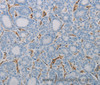Immunohistochemistry of paraffin-embedded Human thyroid cancer tissue using CD31 Polyclonal Antibody at dilution 1:40