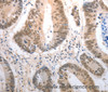 Immunohistochemistry of paraffin-embedded Human colon cancer using RAD50 Polyclonal Antibody at dilution of 1:40