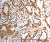 Immunohistochemistry of paraffin-embedded Human gastric cancer using RAD50 Polyclonal Antibody at dilution of 1:40