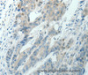 Immunohistochemistry of paraffin-embedded Human colon cancer using RNF126 Polyclonal Antibody at dilution of 1:70