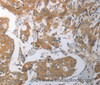 Immunohistochemistry of paraffin-embedded Human breast cancer tissue using SHH Polyclonal Antibody at dilution 1:70