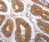 Immunohistochemistry of paraffin-embedded Human colon cancer tissue using SLC12A6 Polyclonal Antibody at dilution 1:40