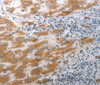 Immunohistochemistry of paraffin-embedded Human liver cancer tissue using SLC12A6 Polyclonal Antibody at dilution 1:40