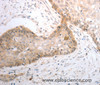 Immunohistochemistry of paraffin-embedded Human cervical cancer using SLC1A4 Polyclonal Antibody at dilution of 1:40