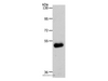 Western Blot analysis of Human colon cancer tissue using SLC39A6 Polyclonal Antibody at dilution of 1:500