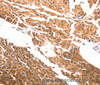 Immunohistochemistry of paraffin-embedded Human cervical cancer using SLC39A6 Polyclonal Antibody at dilution of 1:30