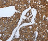 Immunohistochemistry of paraffin-embedded Human breast cancer tissue using SLC34A2 Polyclonal Antibody at dilution of 1:70