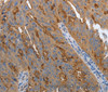 Immunohistochemistry of paraffin-embedded Human ovarian cancer using SLC34A2 Polyclonal Antibody at dilution of 1:70