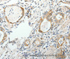 Immunohistochemistry of paraffin-embedded Human gastric cancer tissue using GEMIN2 Polyclonal Antibody at dilution 1:40