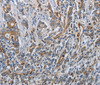 Immunohistochemistry of paraffin-embedded Human gastric cancer using SOCS1 Polyclonal Antibody at dilution of 1:70
