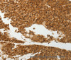 Immunohistochemistry of paraffin-embedded Human liver cancer tissue using SOCS7 Polyclonal Antibody at dilution 1:30