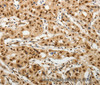 Immunohistochemistry of paraffin-embedded Human lung cancer tissue using SOCS7 Polyclonal Antibody at dilution 1:30