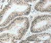 Immunohistochemistry of paraffin-embedded Human colon cancer tissue using HNF1B Polyclonal Antibody at dilution 1:80