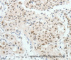 Immunohistochemistry of paraffin-embedded Human lung cancer tissue using HNF1B Polyclonal Antibody at dilution 1:80