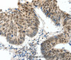 Immunohistochemistry of paraffin-embedded Human colon cancer tissue using TOP2A Polyclonal Antibody at dilution 1:30