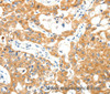 Immunohistochemistry of paraffin-embedded Human lung cancer using TRAF3 Polyclonal Antibody at dilution of 1:40