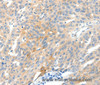 Immunohistochemistry of paraffin-embedded Human ovarian cancer tissue using NTRK1 Polyclonal Antibody at dilution 1:90