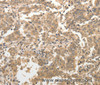 Immunohistochemistry of paraffin-embedded Human gasrtic cancer tissue using ADAR Polyclonal Antibody at dilution 1:40