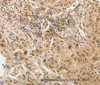 Immunohistochemistry of paraffin-embedded Human lung cancer tissue using ADAR Polyclonal Antibody at dilution 1:40