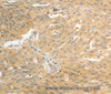 Immunohistochemistry of paraffin-embedded Human ovarian cancer using AKR1C1 Polyclonal Antibody at dilution of 1:30