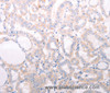 Immunohistochemistry of paraffin-embedded Human thyroid cancer tissue using ANKRA2 Polyclonal Antibody at dilution 1:50