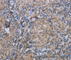 Immunohistochemistry of paraffin-embedded Human thyroid cancer using CDC16 Polyclonal Antibody at dilution of 1:50